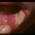 Hier wird eine starke Veränderung der Lippe bei einer Herpesinfektion abgebildet.