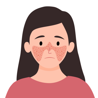 Frau mit dem Lupus Symptom Schmetterlingserythem.